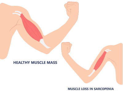 Loss of muscle mass and muscle strength